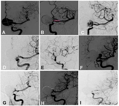 Risk factors for repeated recurrence of cerebral aneurysms treated with endovascular embolization